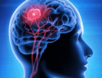 Glioma Otak Kesehatan