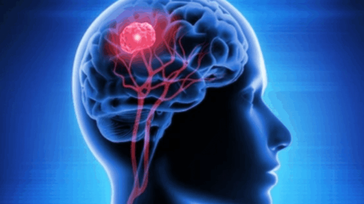 Glioma Otak Kesehatan